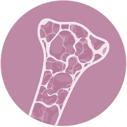 osteoporóza košice